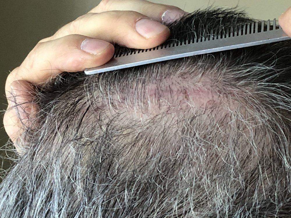 11 weeks post Scar Exposed Right side  2950.JPG