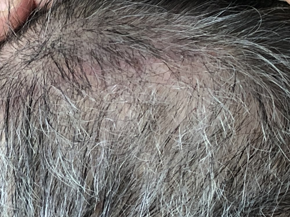 11 weeks post Scar Exposed side  2948.JPG