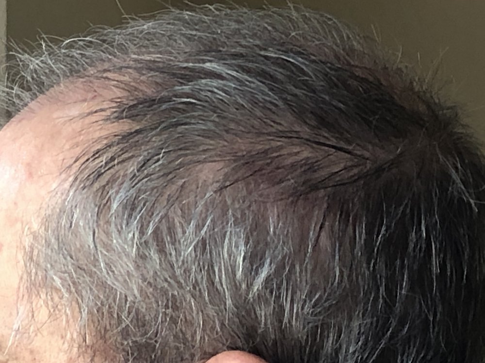 11 weeks post Scar Left side 2933.JPG