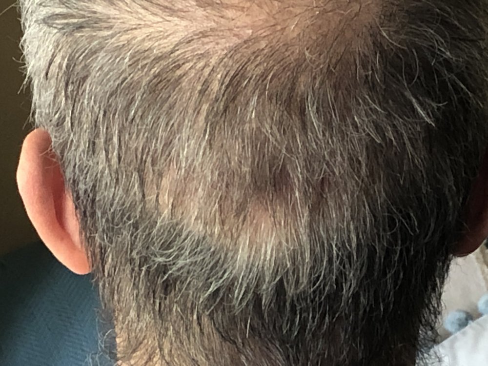 11 weeks post Scar Rear 2932.JPG