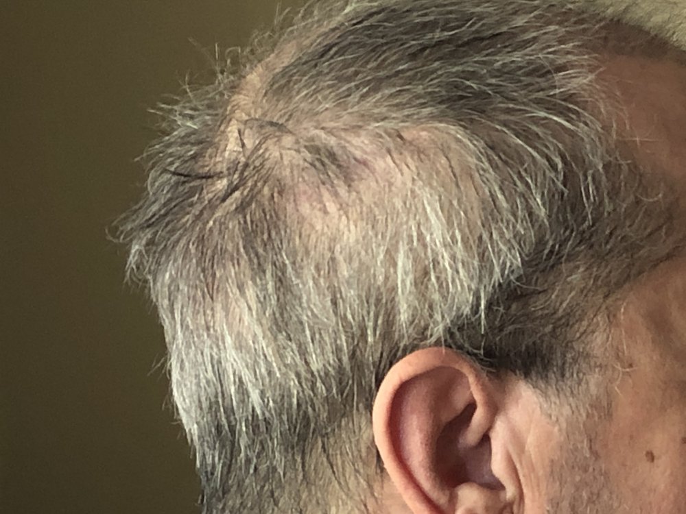 11 weeks post Scar Right side  2938.JPG