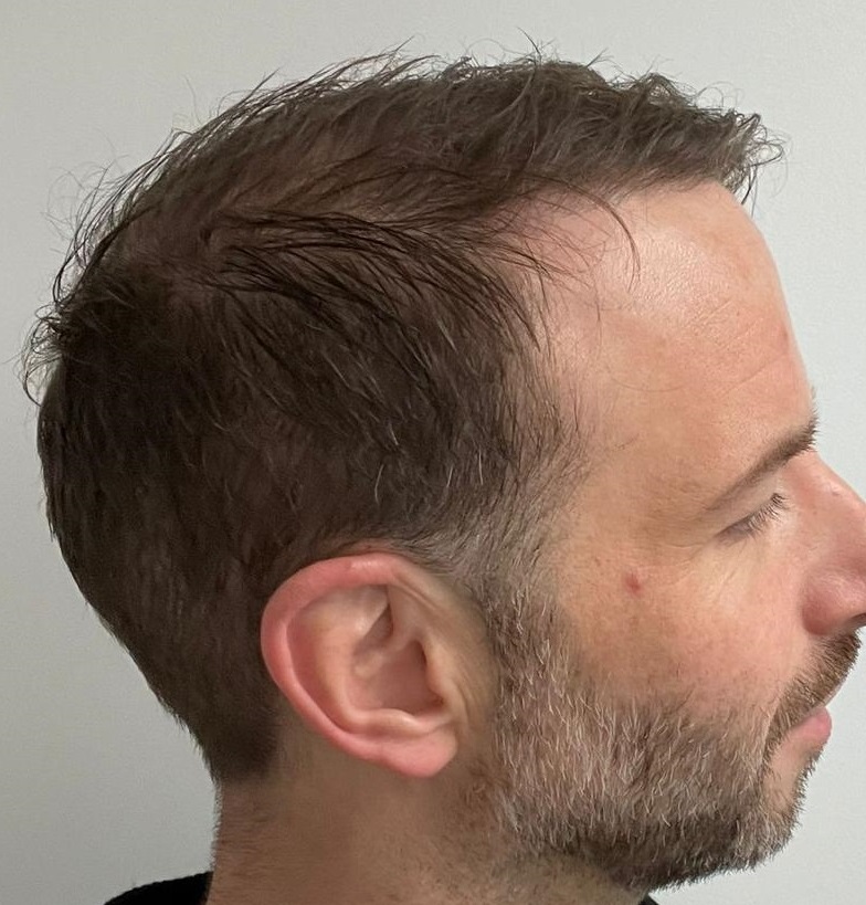 12 After Right side showing donor and result.jpg