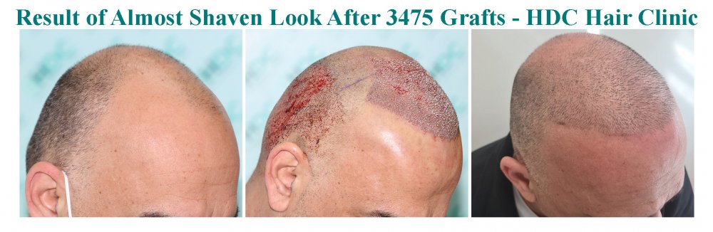 12. Comparison 21-04-21 for 3475 grafts.jpg