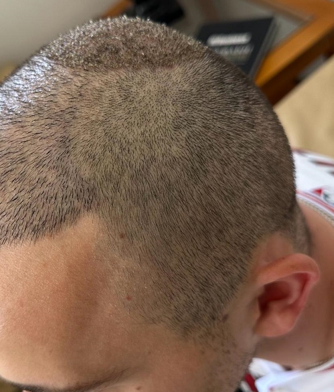 12. Four days After side donor.jpg