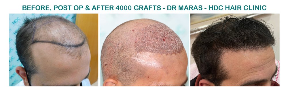 12. Medium 4000 grafts -.jpg