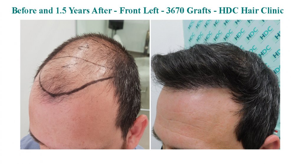 12 - Medium Density HT 28-09-20 for 3670 grafts - Front 3.jpg