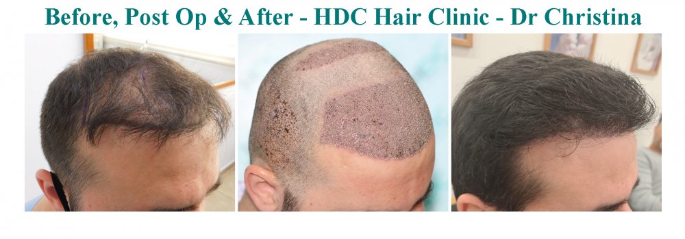 12. Medium HT 28-06-21 - 3200 + 980 grafts post Jan 22 set 2.jpg