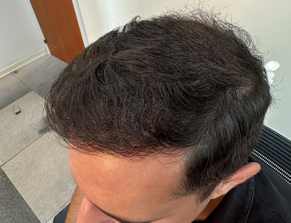 12. Result 8.5 months after Left.jpg