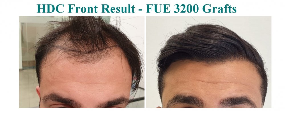 13. 3200 without face.jpg