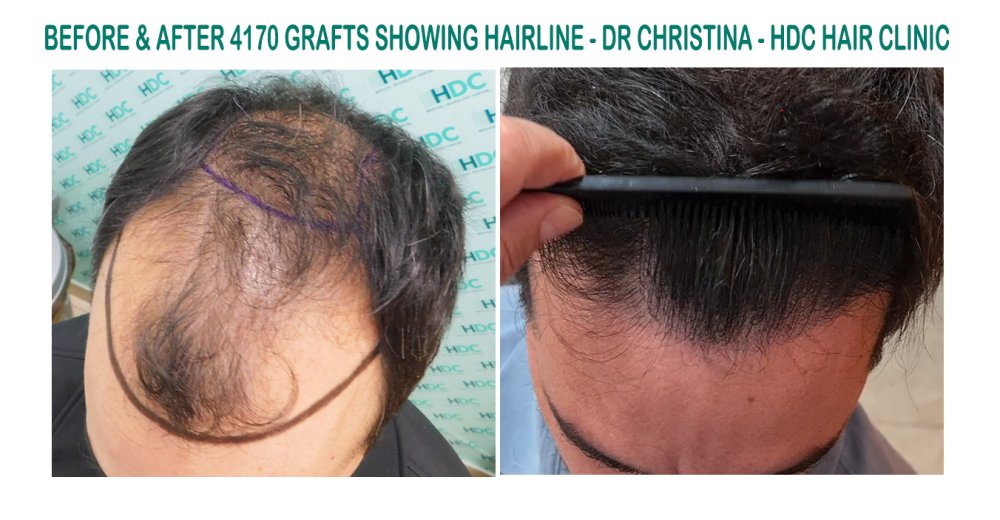 13.  4170 grafts set 3.jpg