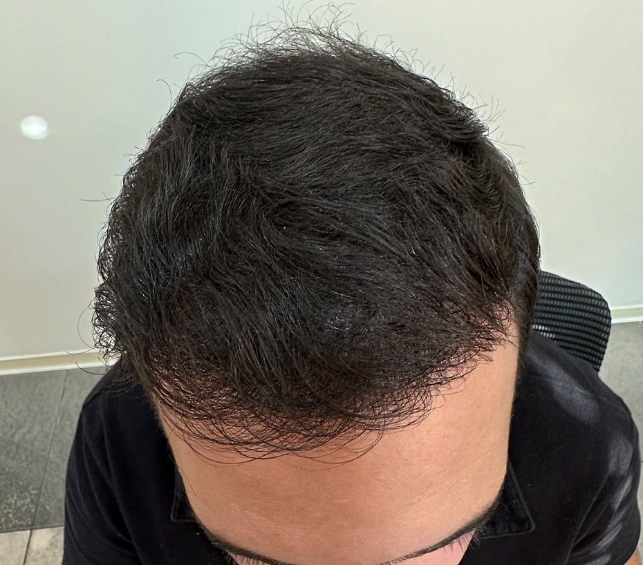 13. Result 8.5 months after Top.jpg