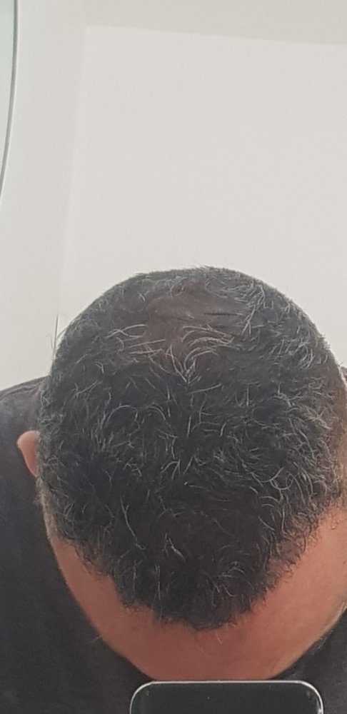 13. Result of FUE2 top view.jpg