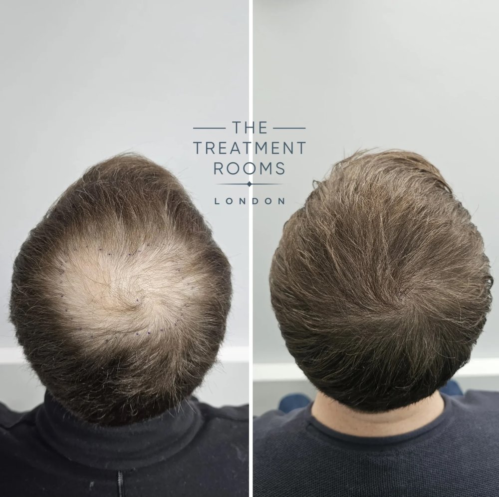 1380-Grafts-FUE-Crown-Hair-Transplant-Before-and-After.jpeg