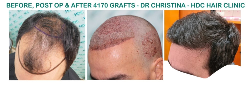 14.  4170 grafts set 1.jpg