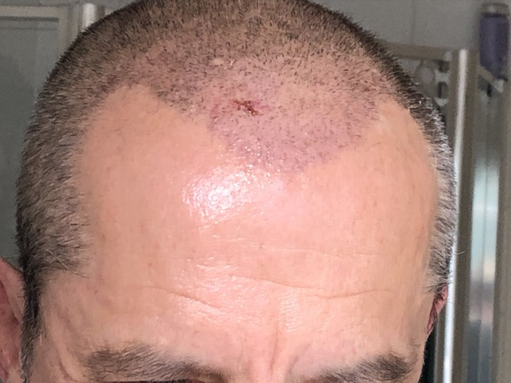 14 days post photo 1.JPG