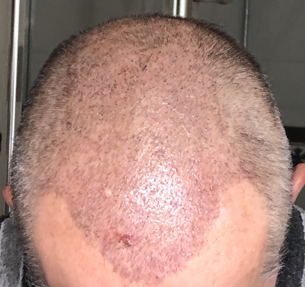 14 days post photo 2.JPG