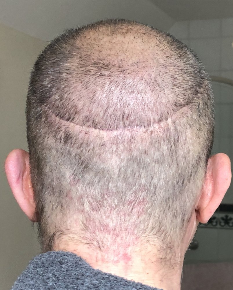 14 days post photo 3.JPG