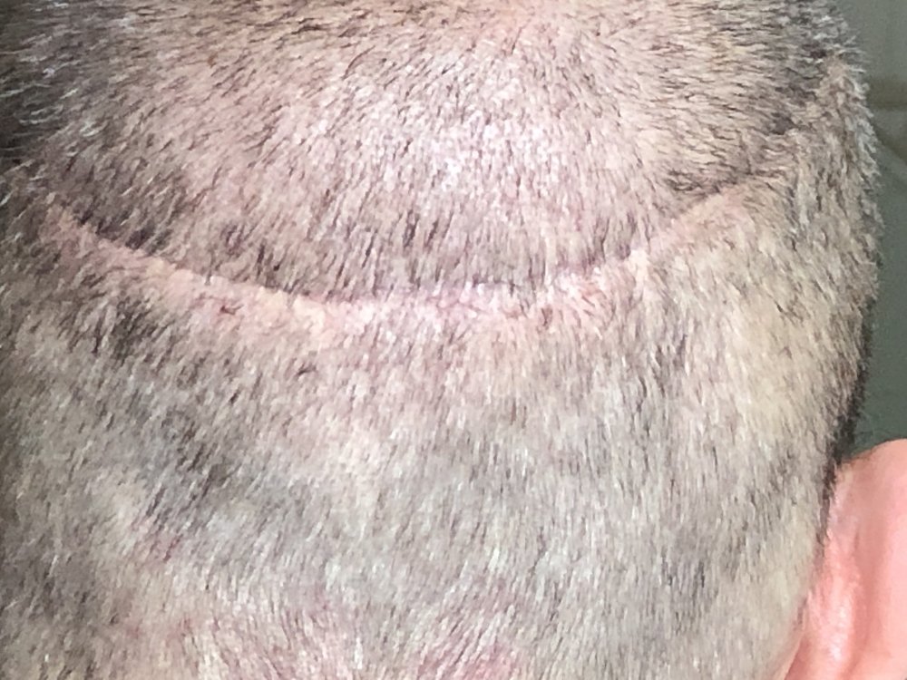 14 days post photo 4.JPG
