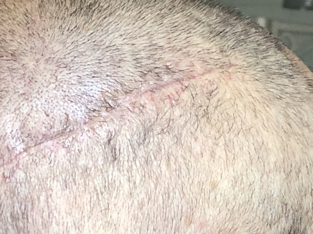 14 days post photo 5.JPG