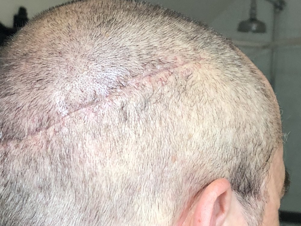 14 days post photo 6.JPG