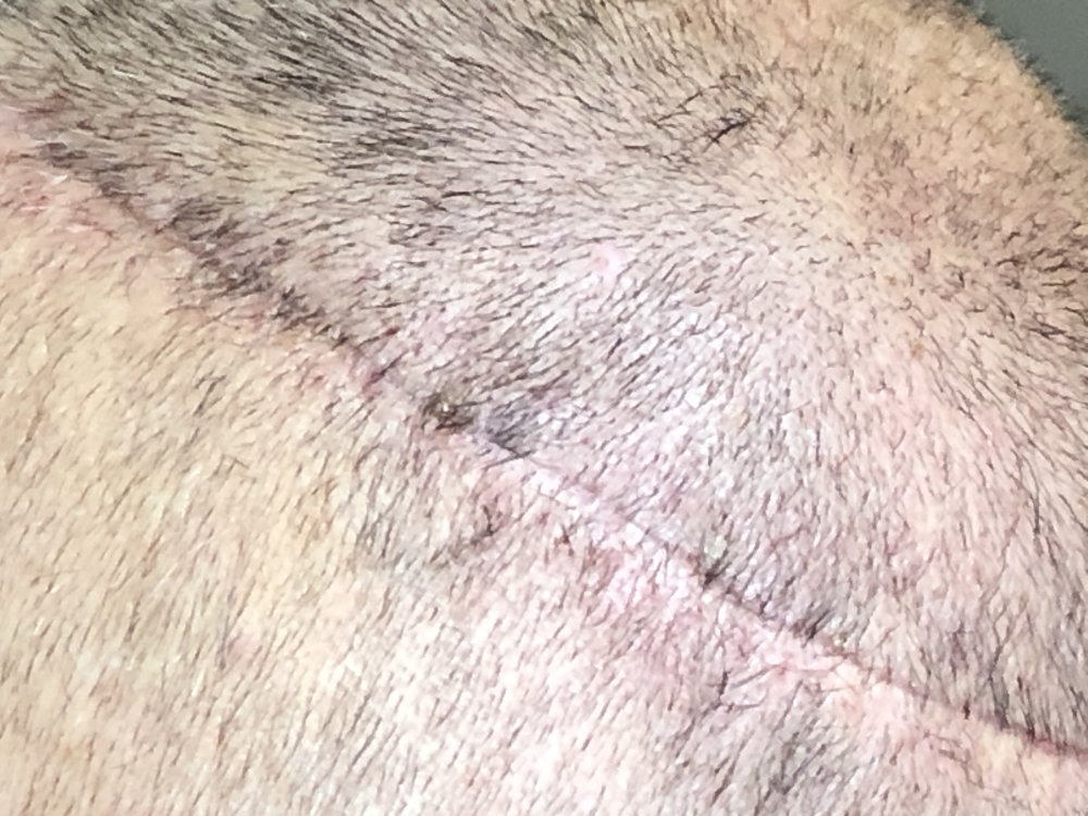 14 days post photo 7.JPG