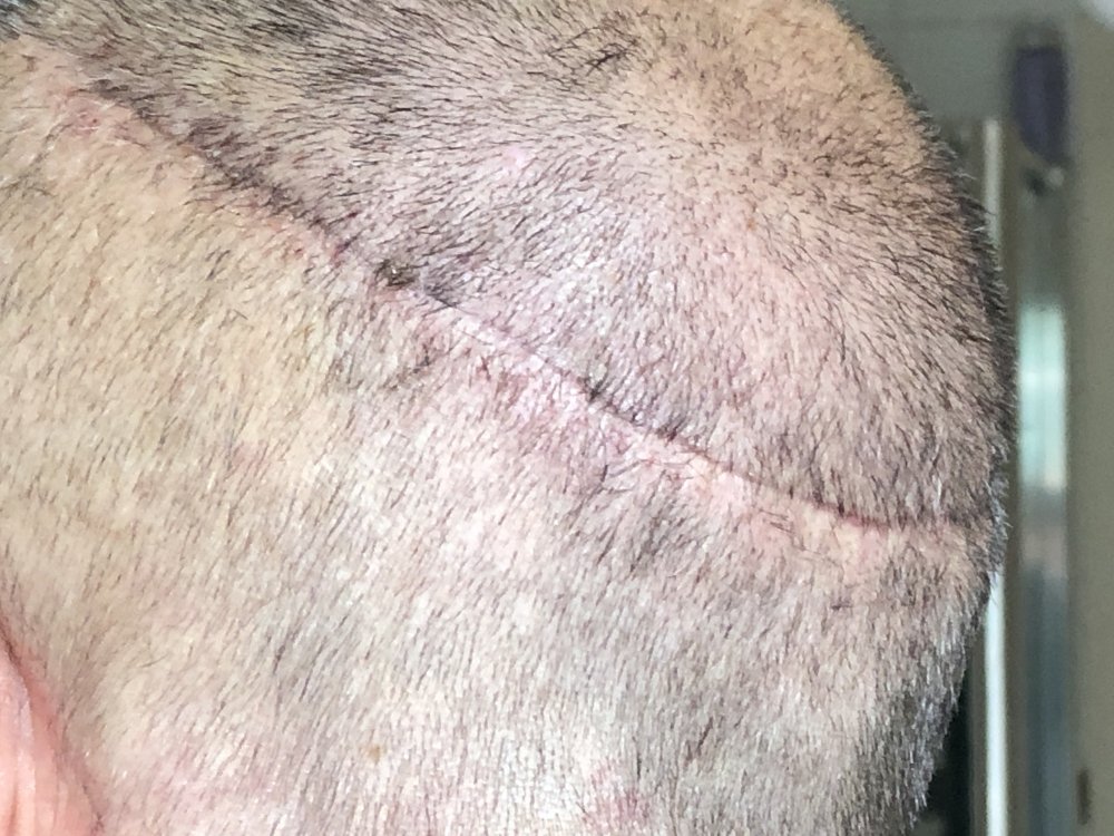 14 days post photo 8.JPG