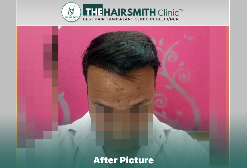 14 months hairsmith hair transplant result - the hairsmith clinic delhi #hairtransplant.JPG