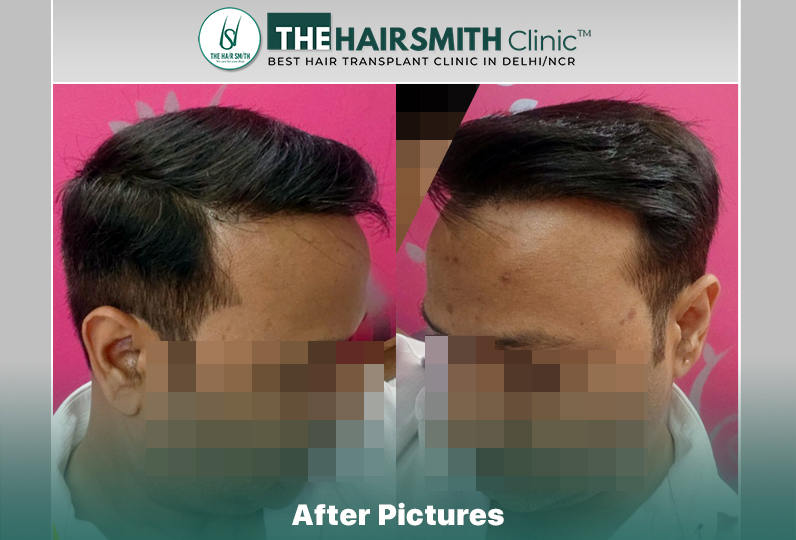 14 months hairsmith hair transplant result - the hairsmith clinic delhi #hairtransplant #theha...JPG