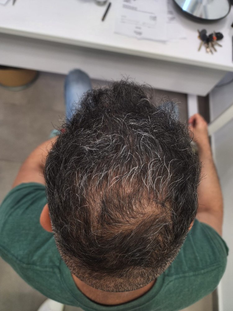 14. Result of FUE2 Top area.jpg