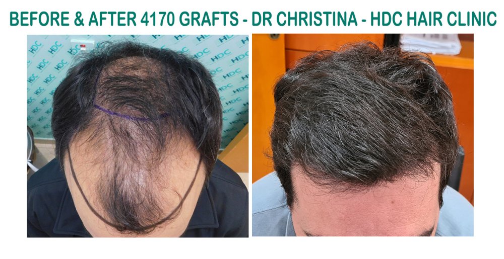 15.   4170 grafts set 2.jpg