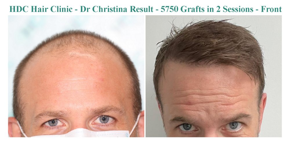 15. Result 5750 grafts 2 sessions.jpg
