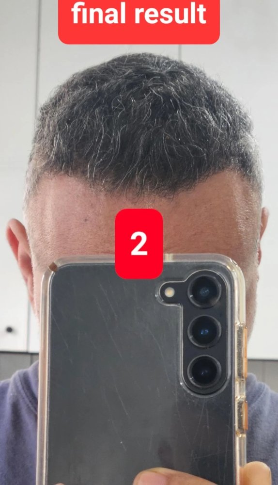 15. Result of FUE2 front.jpg