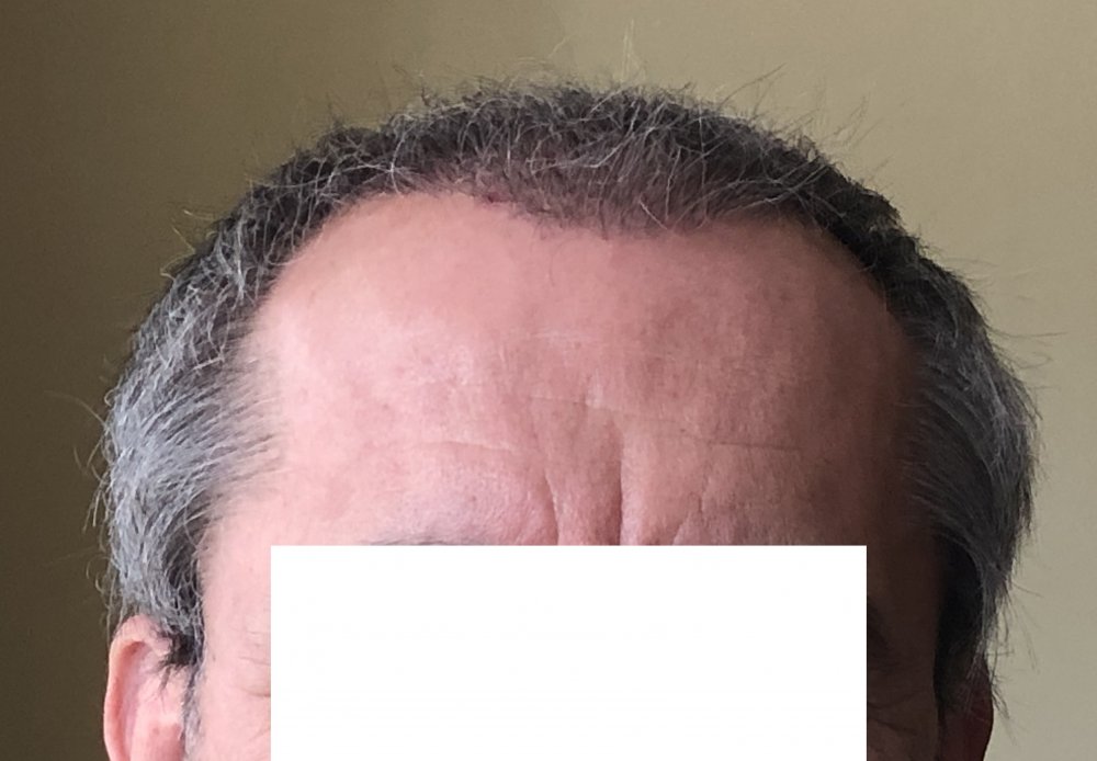 15 weeks post 2986.JPG