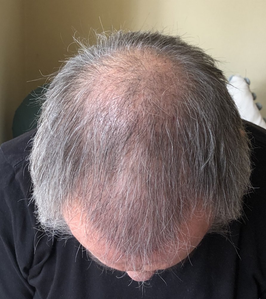 15 weeks post 2987.JPG