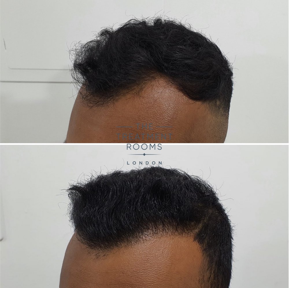 1546 grafts FUE hair transplant before and after.jpg