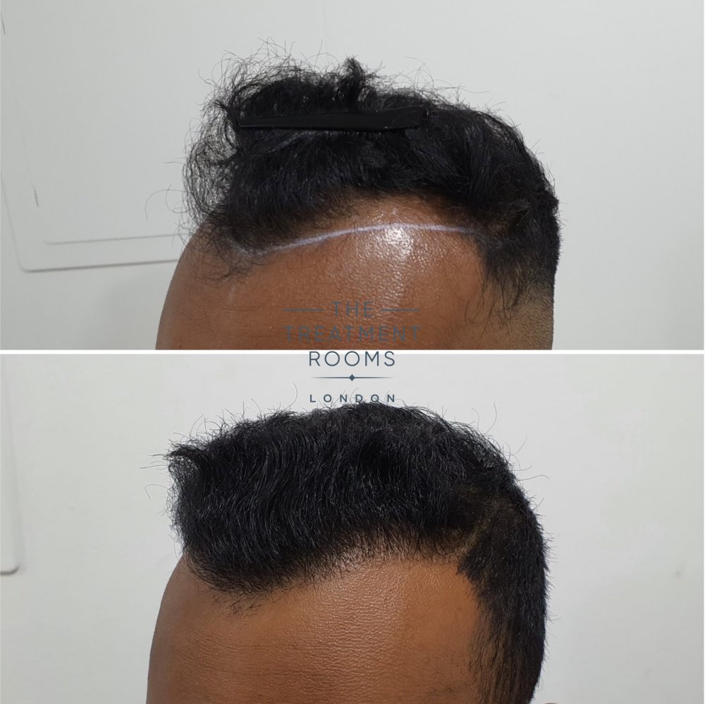 1546 grafts FUE hair transplant london before and after.jpg