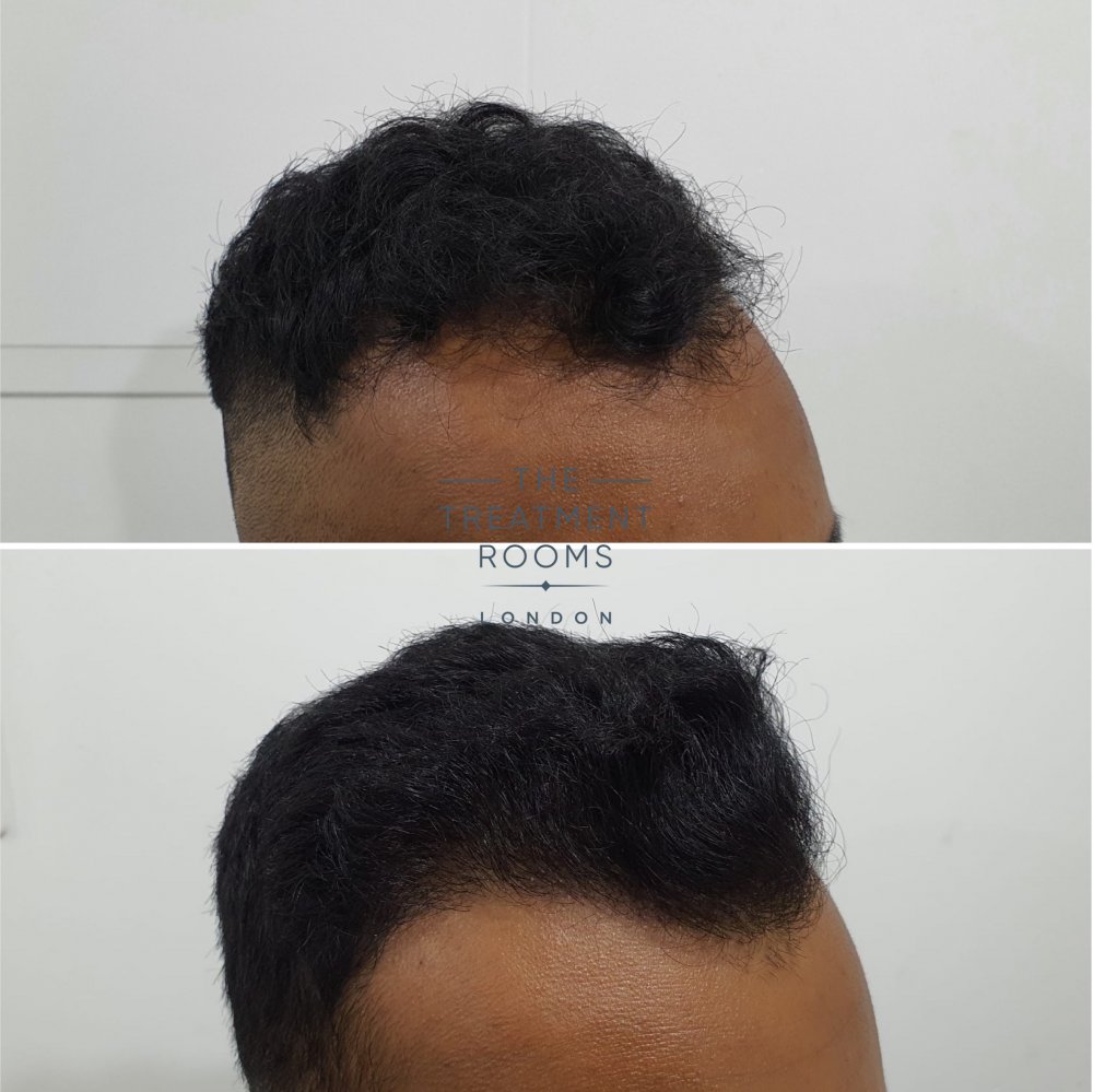 1546 grafts FUE hair transplant london result.jpg