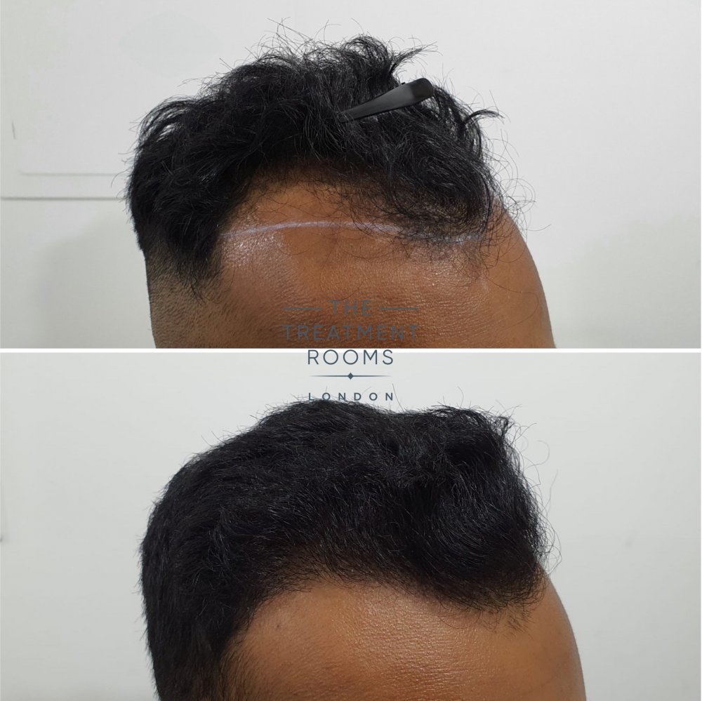 1546 grafts hairline FUE hair transplant.jpg