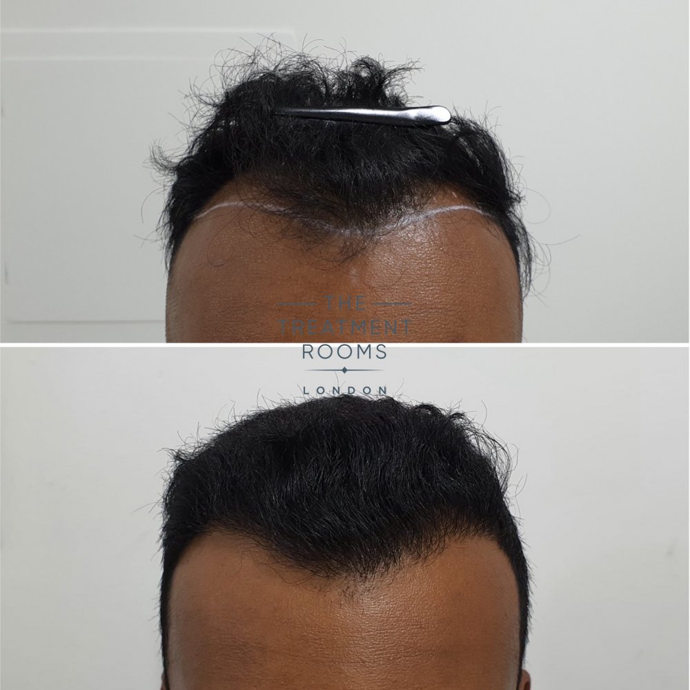 1546 grafts hairline FUE hair transplant result.jpg