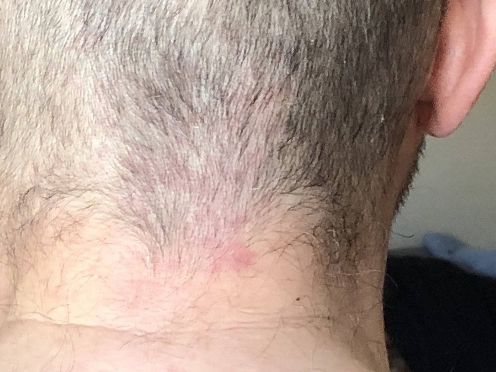 16 days Post Rash#2.JPG