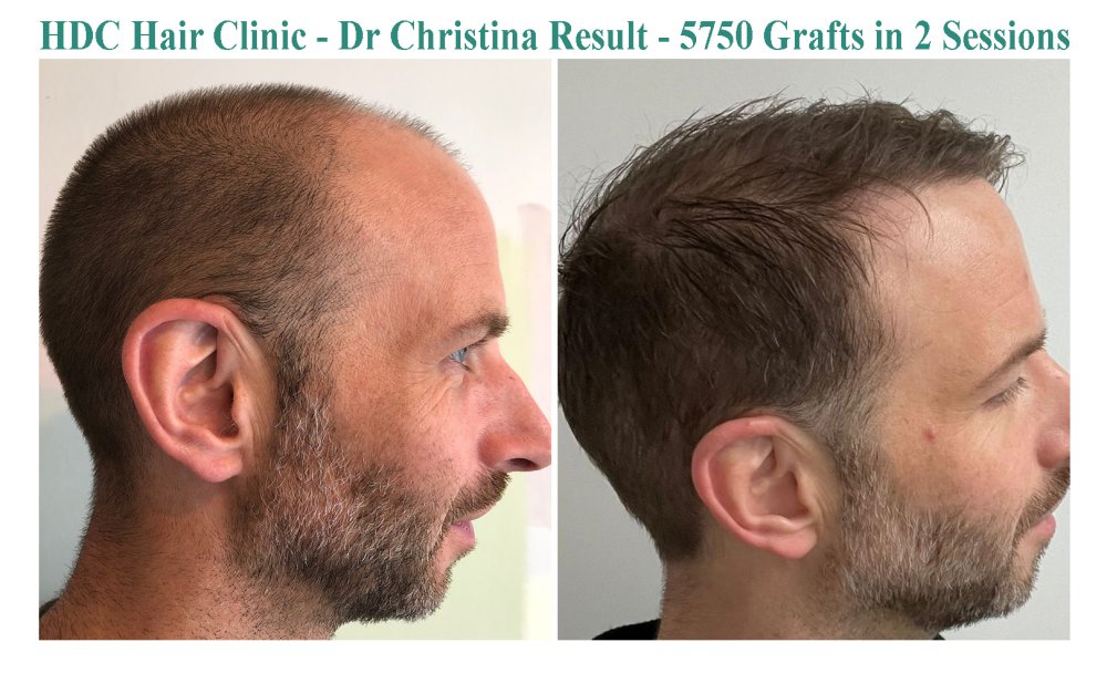 16. Result 5750 grafts 2 sessions Left.jpg