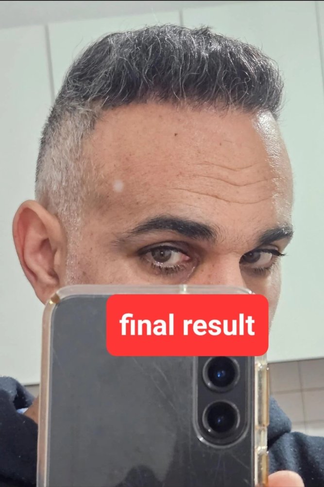 16. Result of FUE2 front.jpg