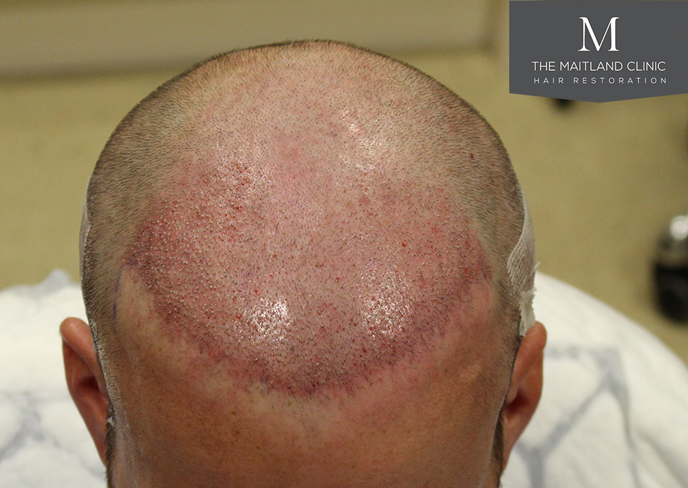 1600 Grafts FUE, The Maitland Clinic, Dr Edward Ball, Day of Surgery 1.jpg