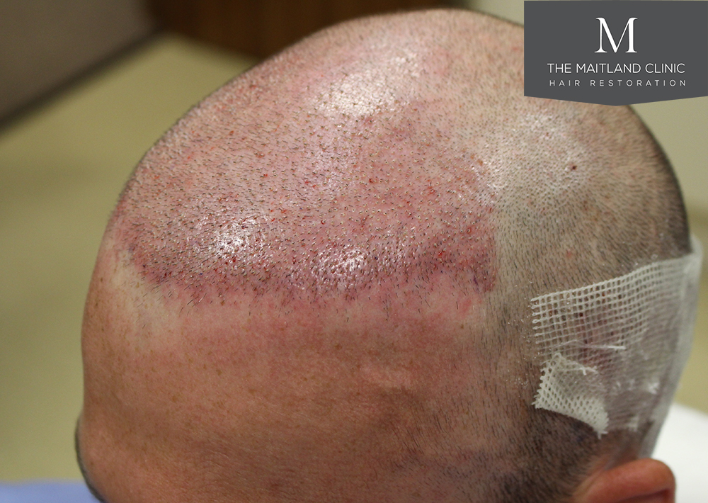 1600 Grafts FUE, The Maitland Clinic, Dr Edward Ball, Day of Surgery 2.jpg