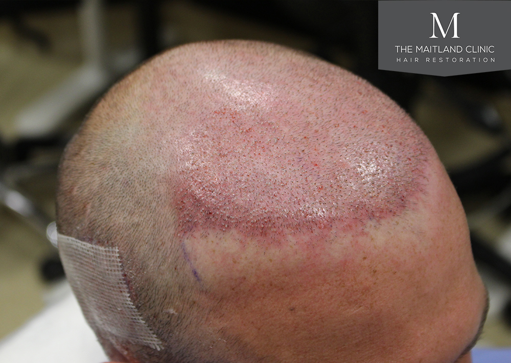 1600 Grafts FUE, The Maitland Clinic, Dr Edward Ball, Day of Surgery 4.jpg