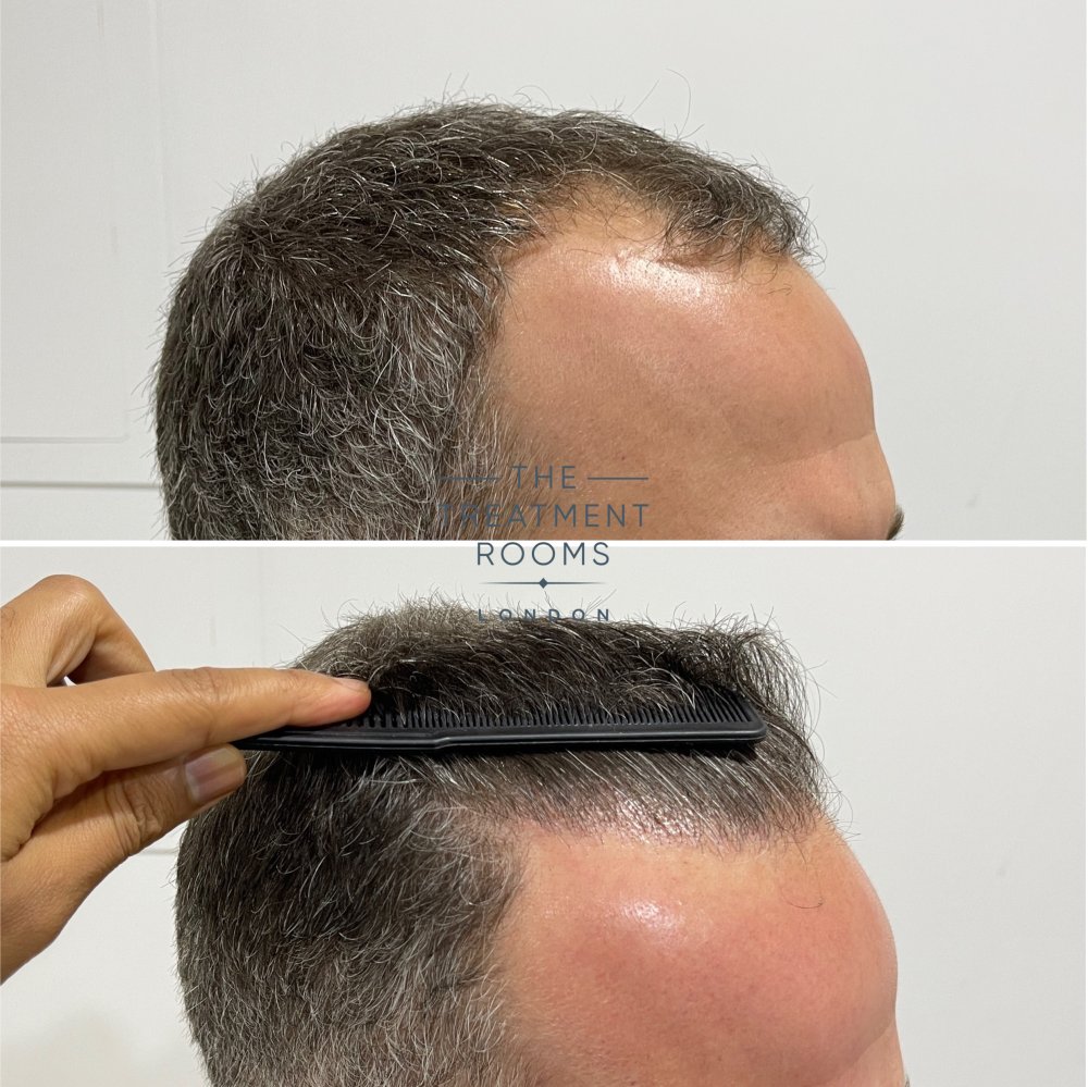 1788 grafts hair transplant before and after.jpg