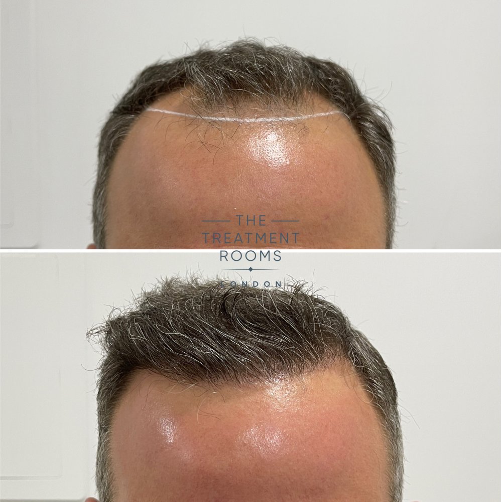 1788 grafts hairline transplant.jpg