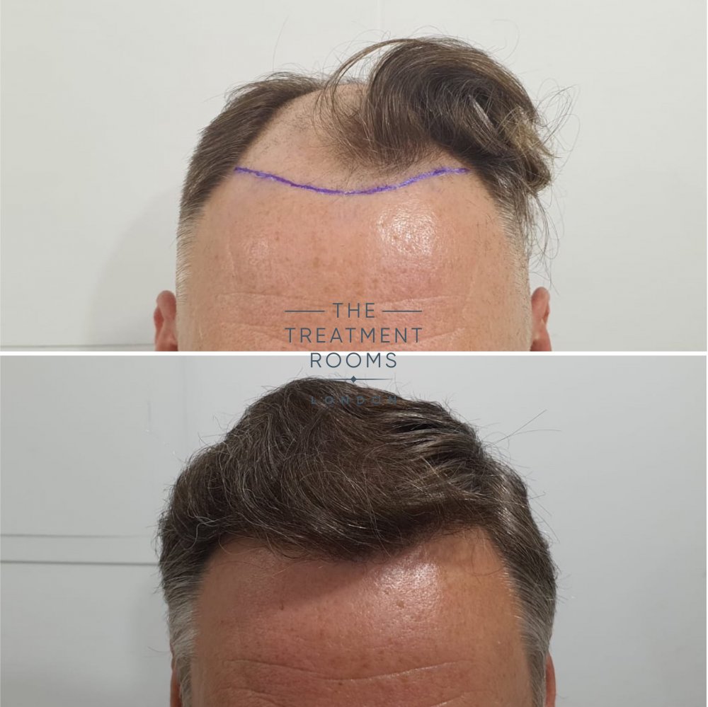 1824 grafts FUE Hair transplant before and after.jpg
