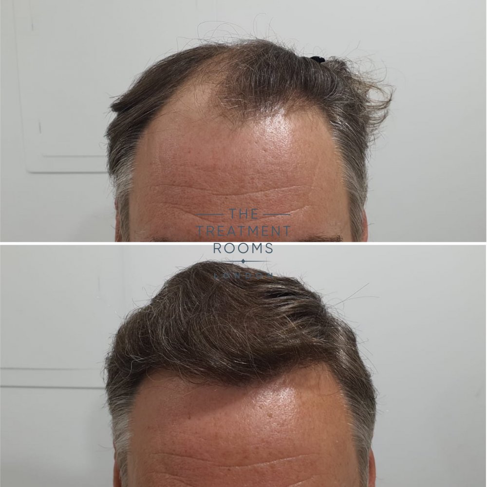 1824 grafts FUE Hair transplant hairline before and after.jpg