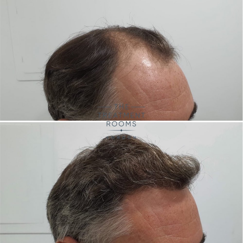 1824 grafts FUE Hair transplant london. jpg.jpg